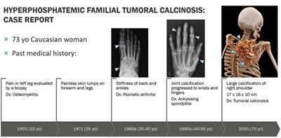 Hyperphosphatemic Familial Tumoral Calcinosis Hidden in Plain Sight for 73 Years: A Case Report